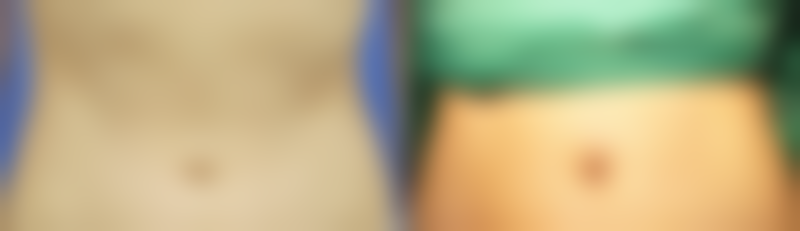 遗传性眼袋黑眼圈可以自愈吗——医美才是你的“救世主”