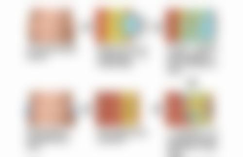 割双眼皮有痕迹能修复吗——修复成效与风险：理性看待特别重要