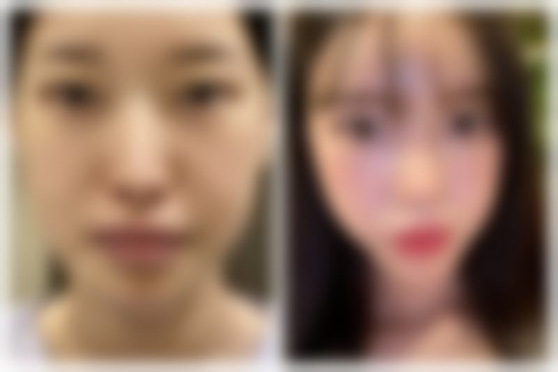 尾段：告别眼袋，重拾明亮双眸