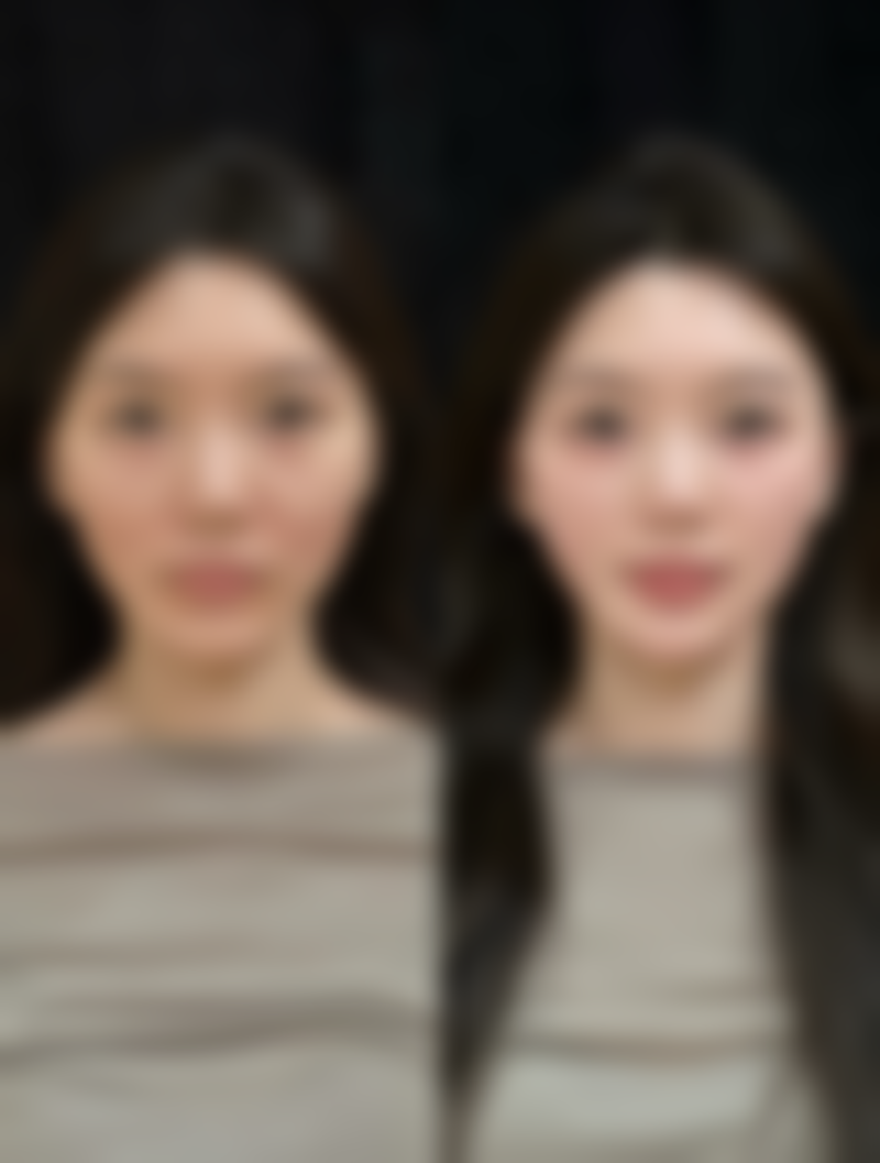 天生的黑眼袋怎么消除:医美手术——一劳永逸的终极解决方案