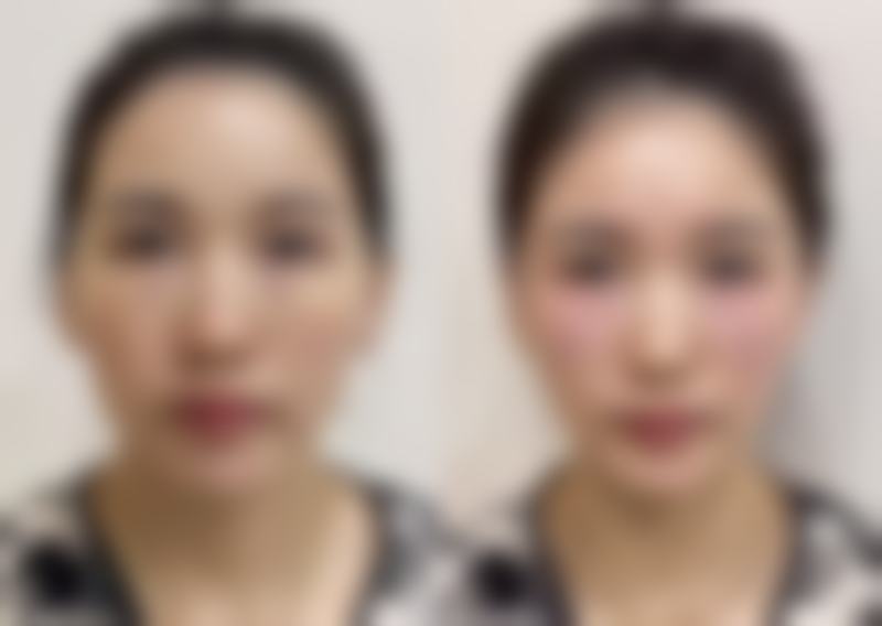 假体隆胸喂奶会下垂吗?对宝宝健康有无影响