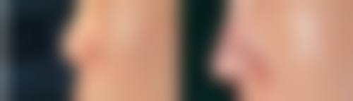 疤痕增生可以修复吗:修复所需时间