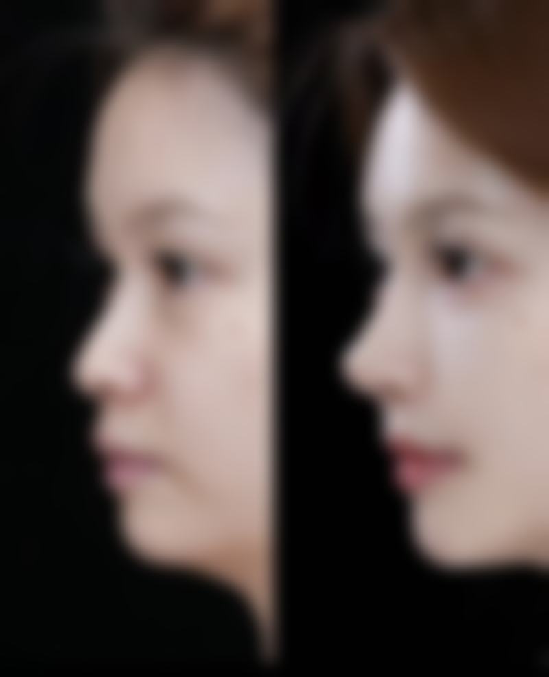 眼袋手术修复时间表：告别“熊猫眼”的精彩倒计时