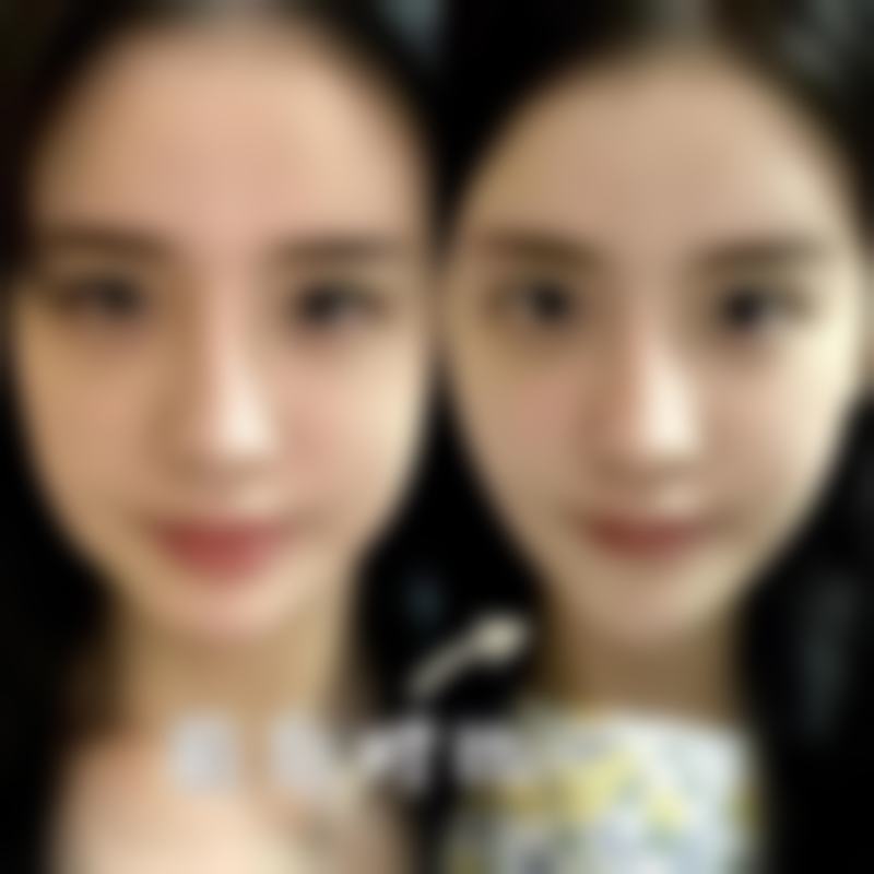 耳软骨复合隆鼻的原理：巧用身体“宝藏”变得更美