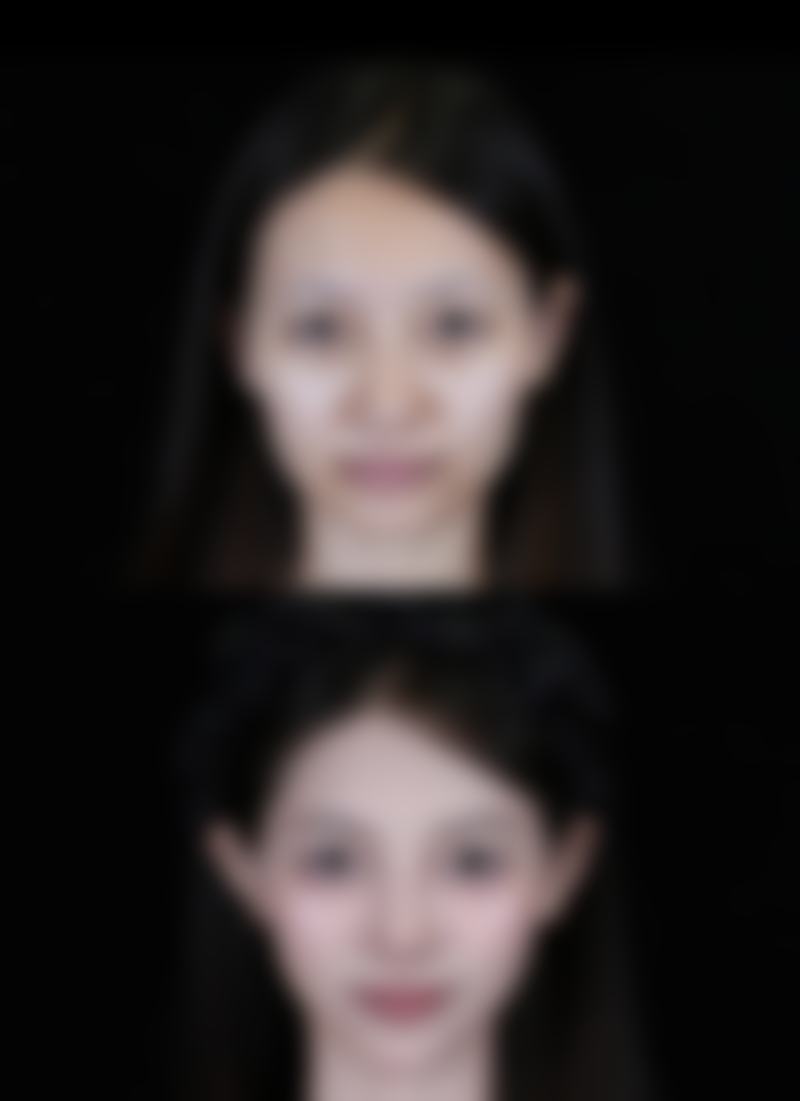 参军身体有手术疤痕可以吗?胸背部手术疤痕负重训练的潜在威胁