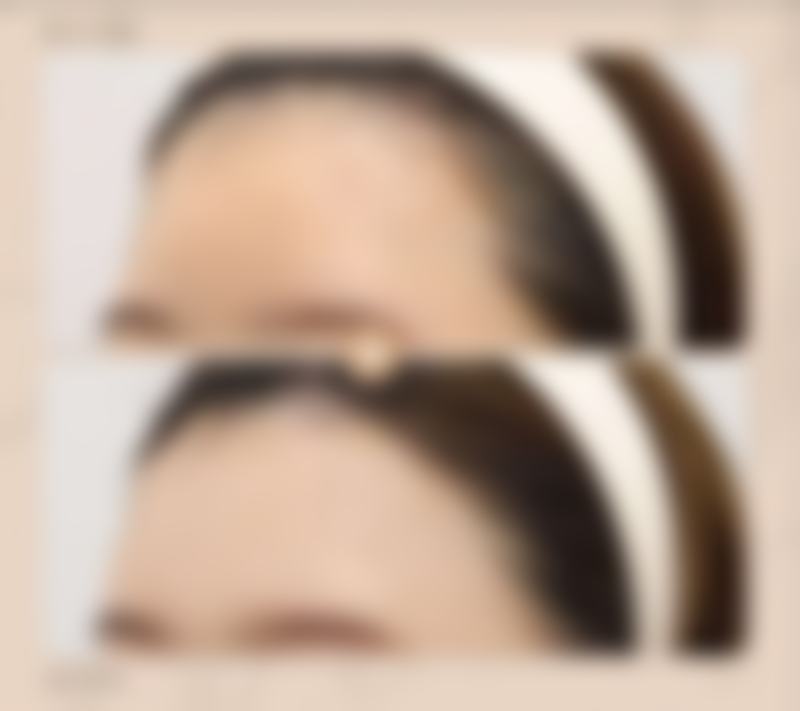 耳软骨复合隆鼻的五大优势：为何备受青睐