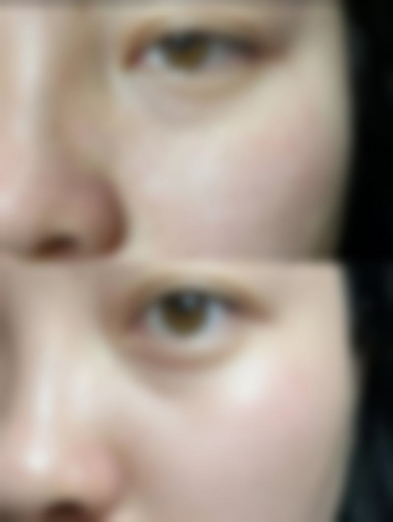 耳软骨复合隆鼻的定义与优势：自体+假体的理想融合