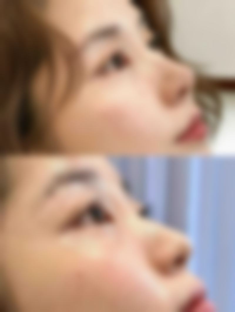 指甲抠的疤痕怎么去除——手术祛疤:末尾的“终极大招”