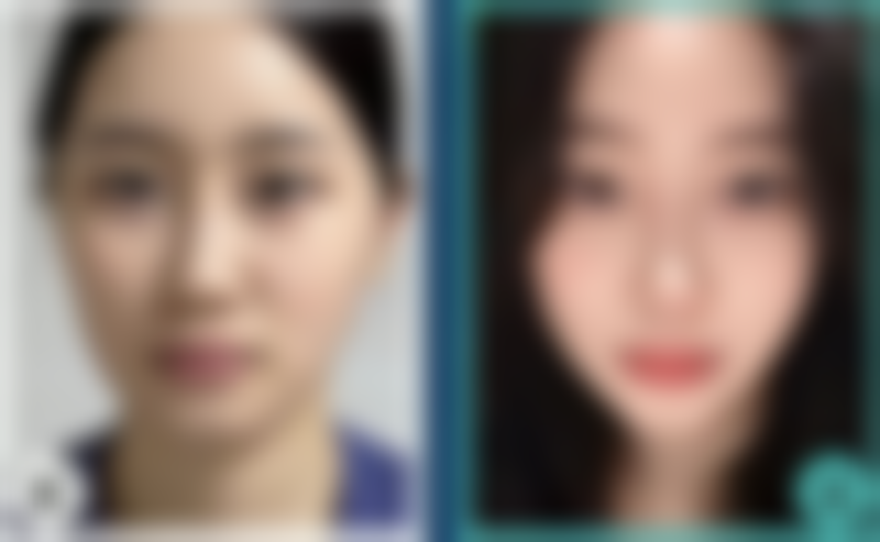 耳软骨复合隆鼻适合人群：看看你是不是理想候选人