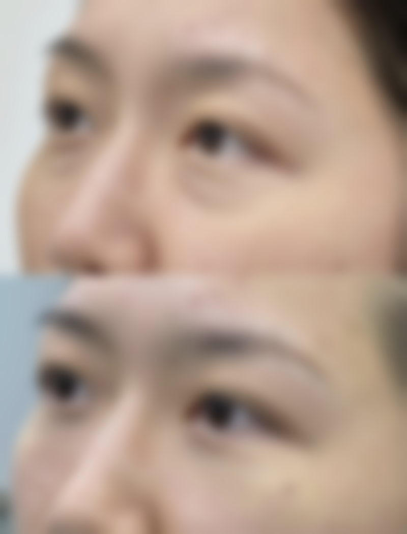 参军身体有手术疤痕可以吗?腿部手术疤痕会成为奔跑的绊脚石吗