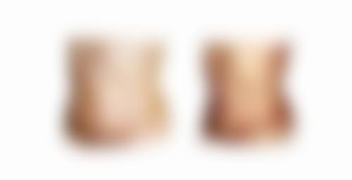 甲状腺手术后有疤痕增生的术后护理指南