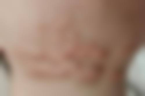 扬州景区安与医疗美容诊所埋线双眼皮术后跟踪服务