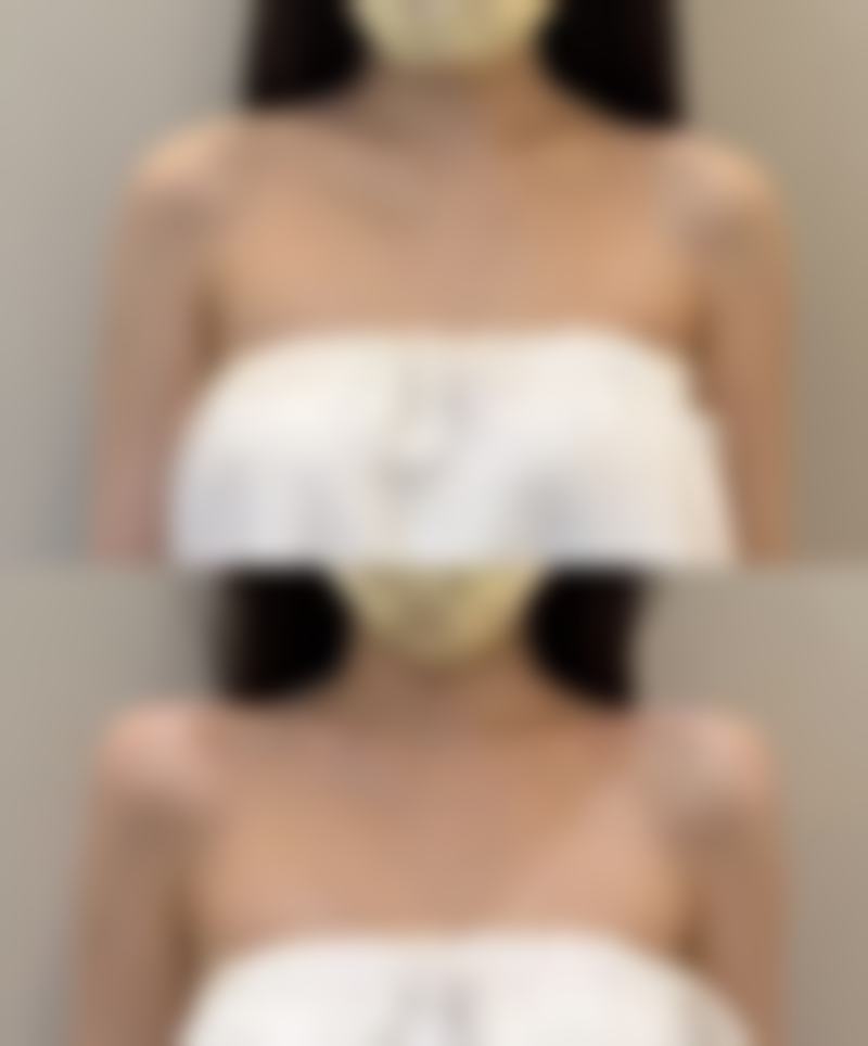 不同类型双眼皮手术的冰敷指南：埋线/切开/微创/修复手术的专属冰敷方案