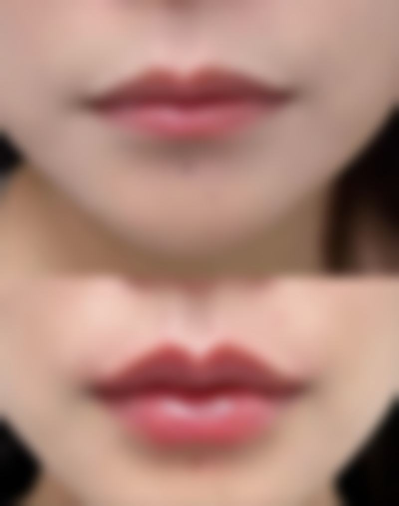 半肋骨隆鼻价格表：为“恒久”投资多少钱