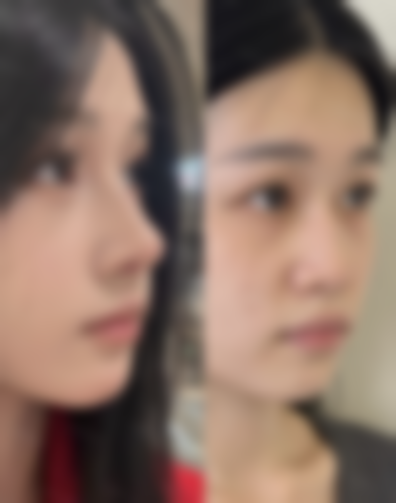 北京三等甲医院半肋骨隆鼻持久成效的材料与技术秘诀