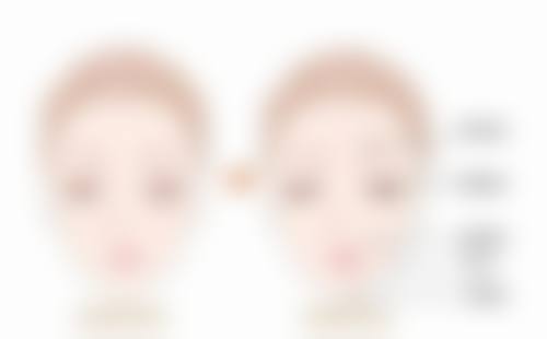 痘痘留下的疤痕怎么办：预防胜于治疗，避免痘疤形成