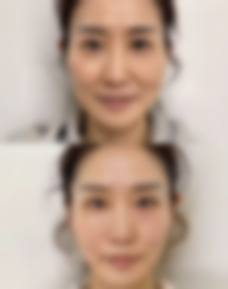 疤痕体质随年龄是否会加重