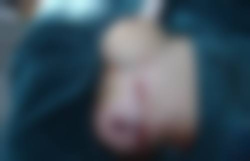 国产 vs 进口：谁的假体更抗造？——质量与价格的权衡