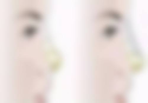 光子嫩肤治疗疤痕的神奇原理大剖析