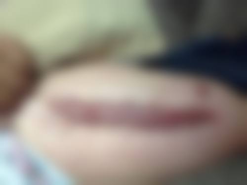 多地消费者医美致残实例（2022年3月15日）