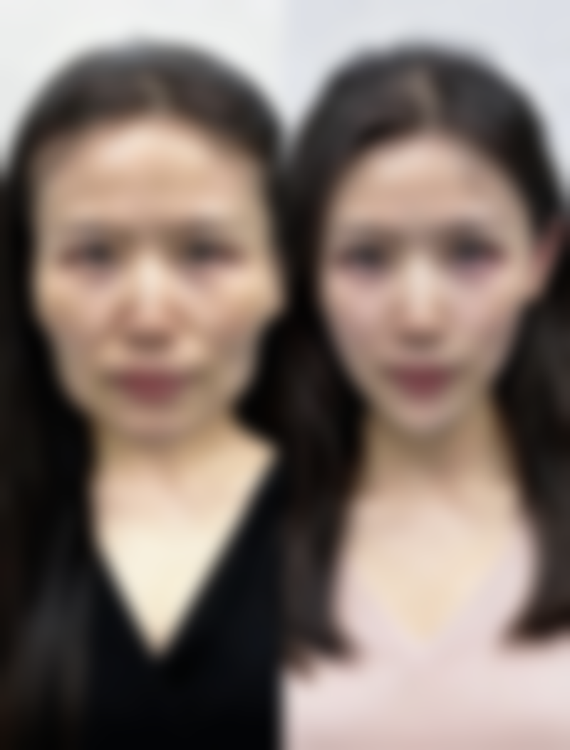 隆胸假体取出会有什么后果之组织粘连：内部的“胶水效应”