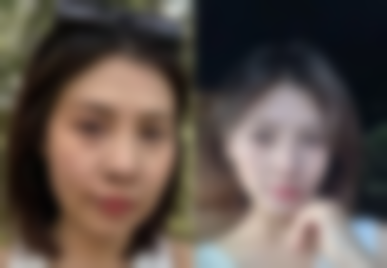 隆胸修复期是多长时间——修复期常见Q&A大解答