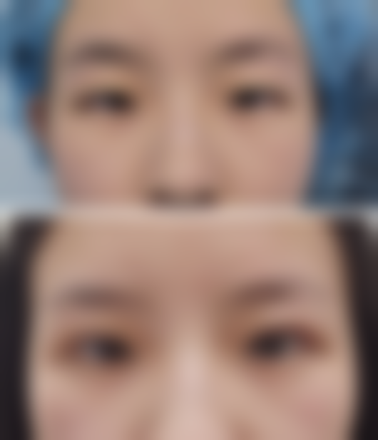 6000元眼部整形哪里好?武汉斯启诺轻医美划算吗