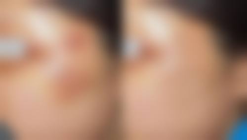 关于瘦脸针药效的常见误区