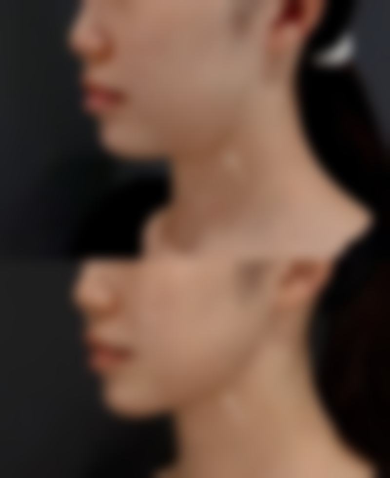 腹部抽脂后泡温泉：特殊部位特殊呵护