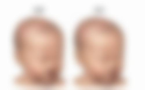 怎么可以在正规医院臀部抽脂：安心是底线