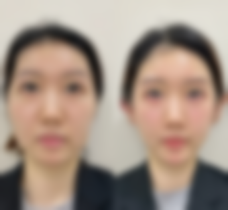 国内医学科学 院整形外科医院揭秘:埋线双眼皮成效能管多少年的四大关键