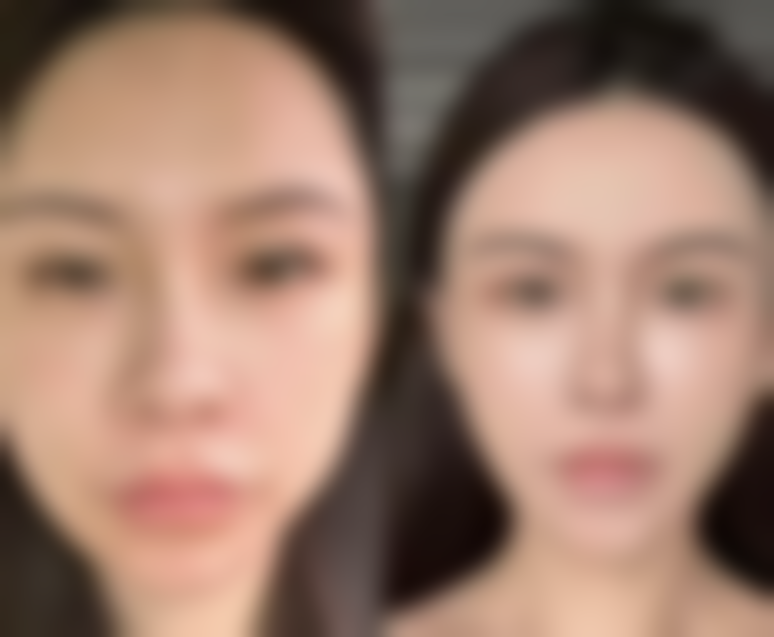 许昌正美韶华医疗美容诊所8000元切开双眼皮的注意事项