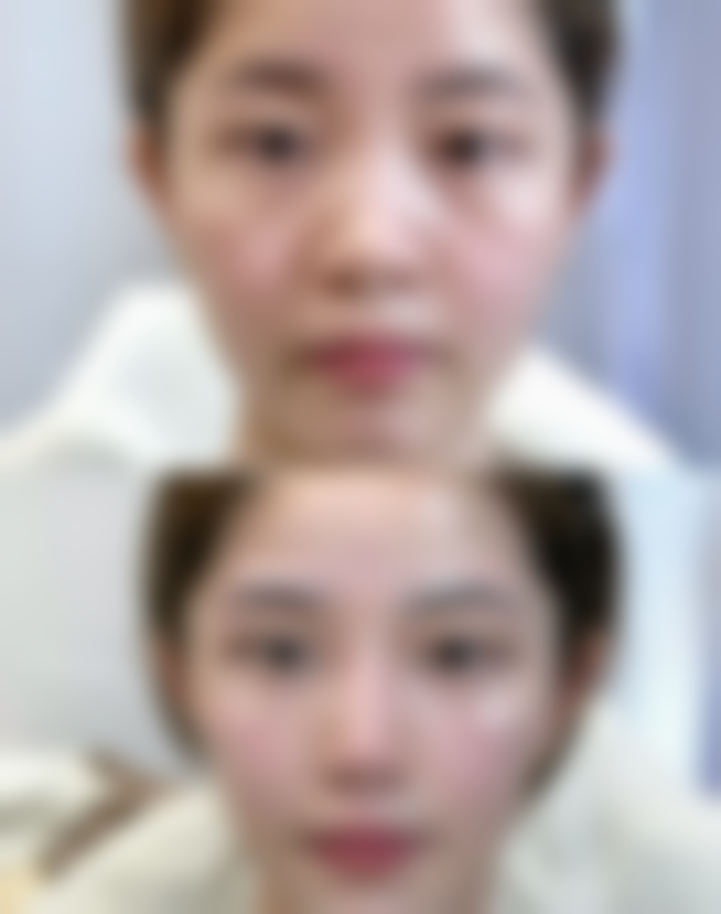 肚子大抽脂会反弹吗?三等甲医院与私立医院的抽脂较量