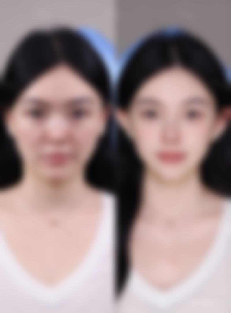 做眼袋手术中年人35 + 手术是否会垮脸