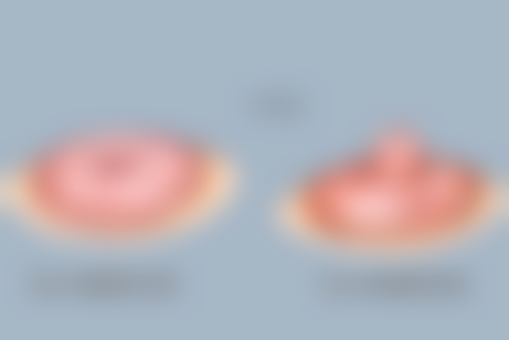 早期修复期(1个月内):伤口未愈与假体未固定的风险,为何不能捏鼻子