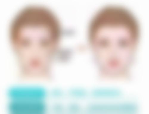 隆胸傲诺拉假体之并发症:风险可控不用怕