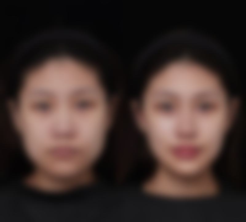 冰敷眼睛消除眼袋的时长把控：科学冰敷时间表