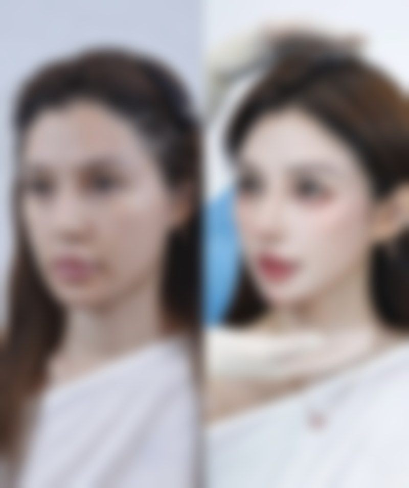 隆胸傲诺拉假体之持久度:十五载美丽相伴