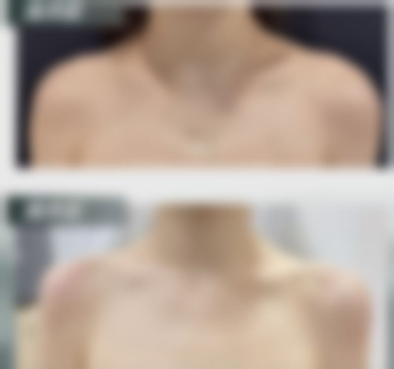 完全修复后(3个月以上):硅胶、膨体与自体软骨的稳定性差异,揉捏指南