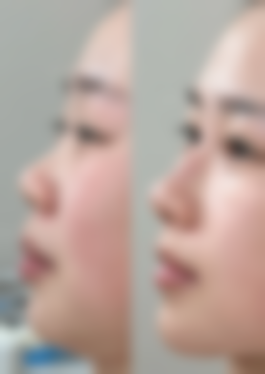 中期修复期(1 - 3个月):轻碰与揉捏的区别,如何安心触碰鼻子