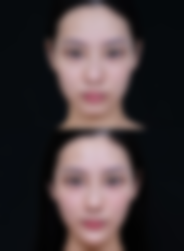 硅胶隆鼻碰到了会怎么样？硅胶特性与处理方法