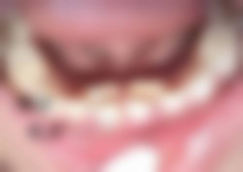 祛痣增生疤痕的自然去除妙招