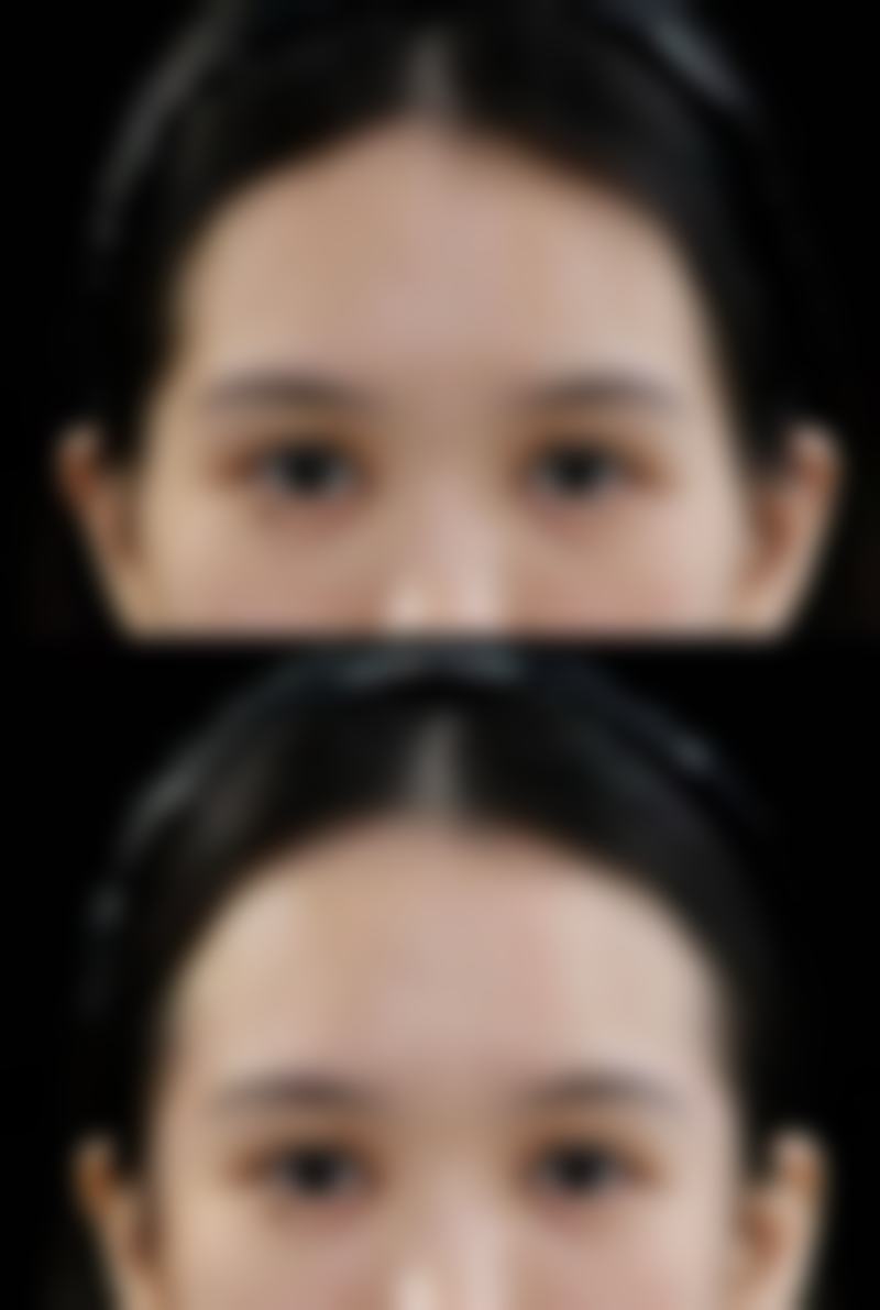 割完双眼皮的红色疤痕什么时候能消：等待期间的容貌管理技巧——心理调适