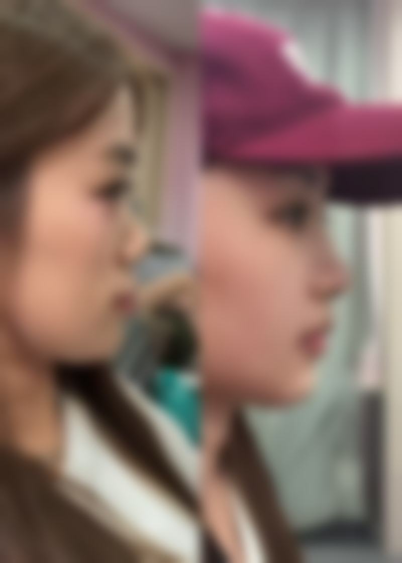 祛痣增生疤痕的日常护理要点