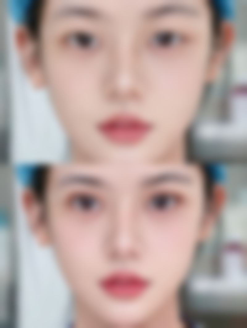 割完双眼皮的红色疤痕什么时候能消：常见误区——这些做法会让你的红疤痕“赖着不走”