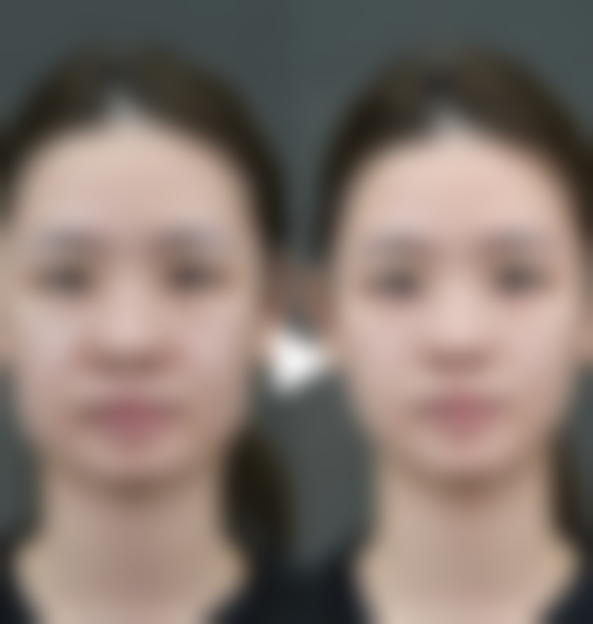 割完双眼皮的红色疤痕什么时候能消：加速红色消退的7个护理秘籍