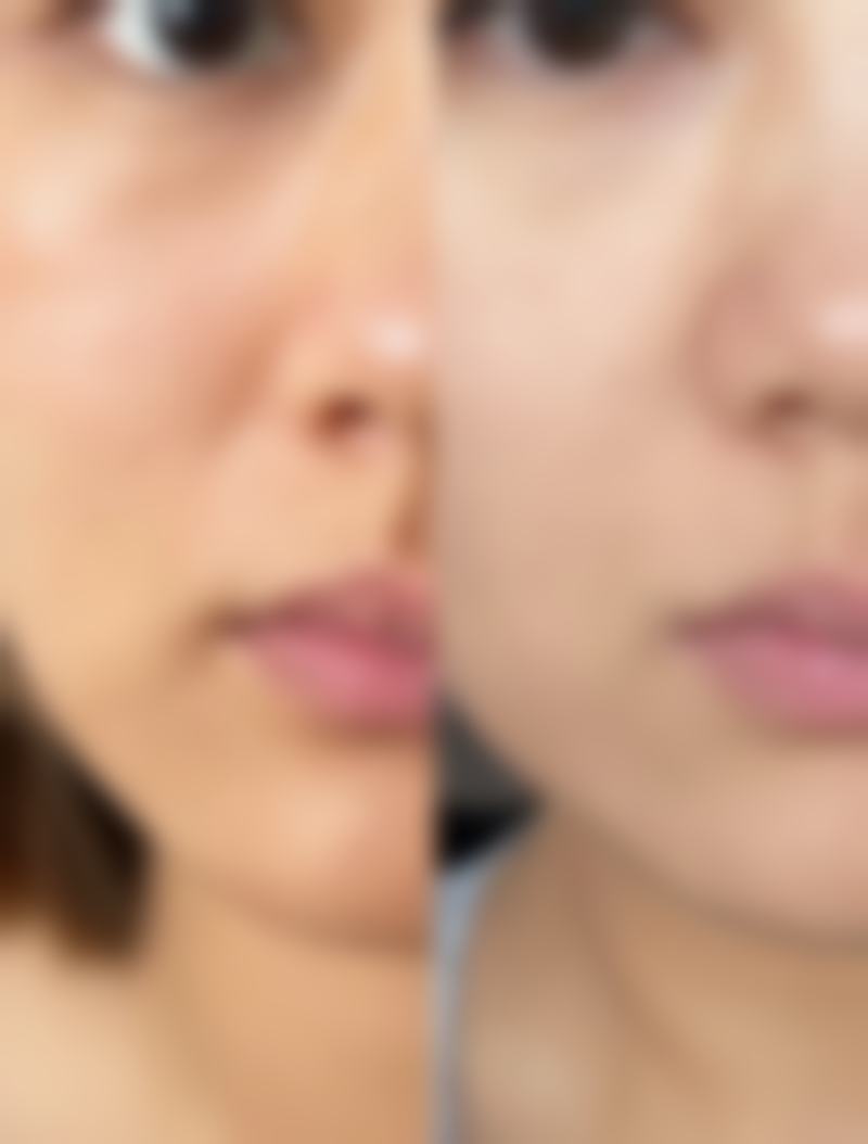 手术疤痕和增生性疤痕的特殊处理