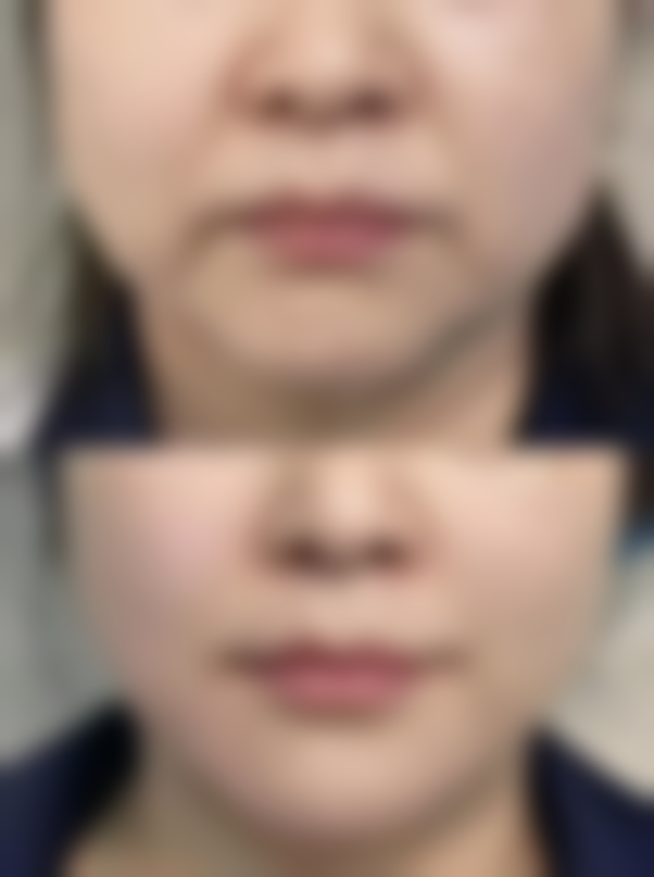 疤痕修复，重获无瑕肌肤不是梦