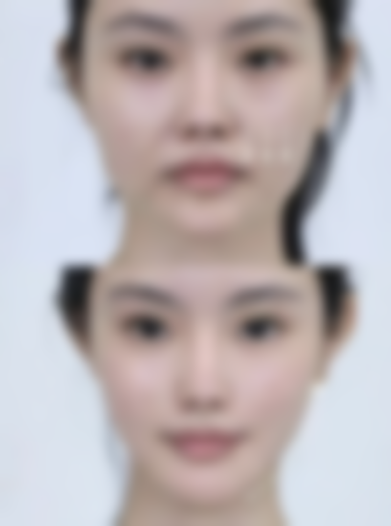 埋线双眼皮宽窄不一何时考虑修复及医生选择