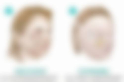 隆鼻山根高怎么办：避免二次手术的5个黄金法则